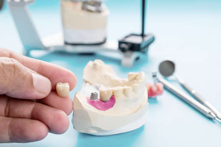 Implant Prosthodontics or Prosthetic / Tooth crown and bridge implant dentistry equipment and model express fix restoration.の写真素材
