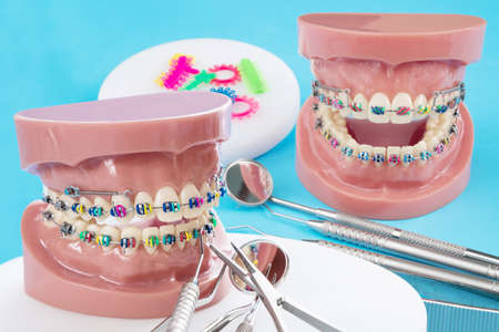 orthodontic model and dentist tool - demonstration teeth model of varities of orthodontic bracket or braceの写真素材