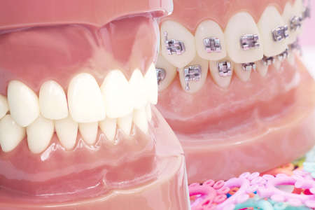 orthodontic model and dentist tool - demonstration teeth model of varities of orthodontic bracket or braceの写真素材