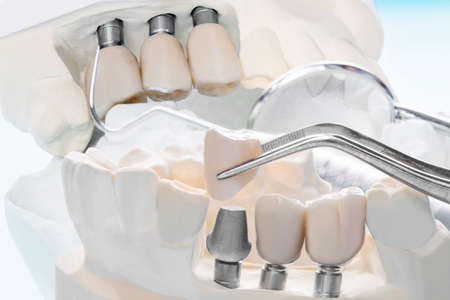 Closeup / Implant Prosthodontics or Prosthetic / Tooth crown and bridge implant dentistry equipment and model express fix restoration.の写真素材