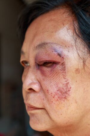 She is asia elderly woman. Her injury to the eyelid swelling from an accident or abused.の写真素材