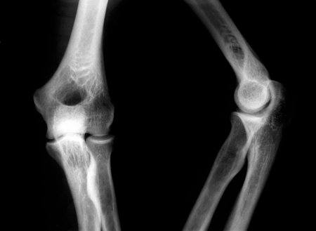X-Ray picture of knees front and side view