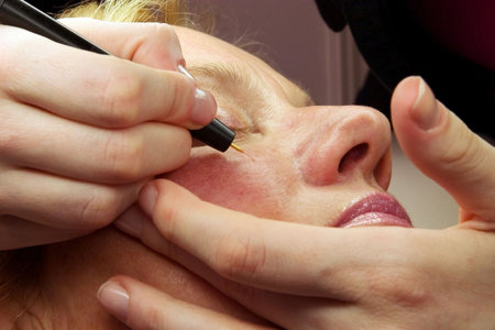 Therapyst healing capillary damage from old face