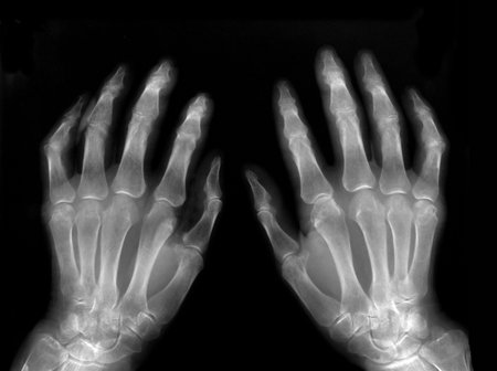 Hands on X-ray filmの写真素材