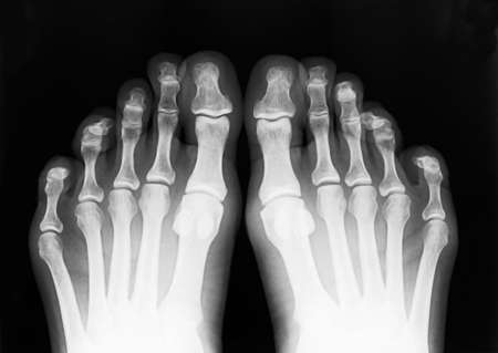 Foot fingers exposed on x-ray black and white filmの写真素材