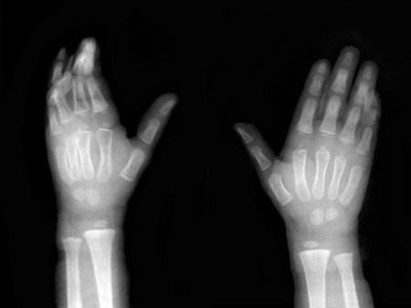 Broken finger on black and white X-ray film
