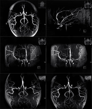 Mri scan of veins in human headの写真素材