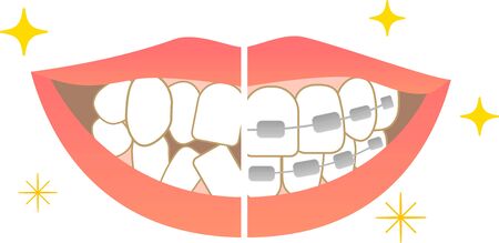 Tooth alignment Dental care Before orthodontic treatment After treatmentのイラスト素材