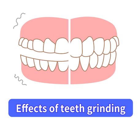 Teeth wear and TCH stress temporomandibular disordersのイラスト素材