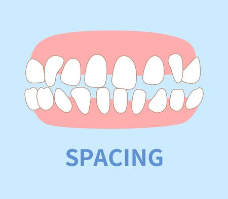 priebus illustrations; crowding, opposite occlusion, open bite, maxillary anterior protrusion, cavities, dentition, crossbiteのイラスト素材