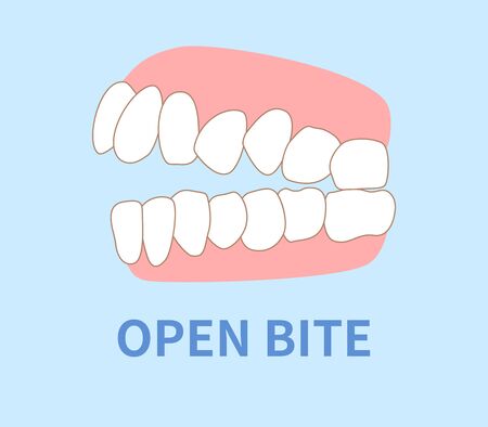 priebus illustrations; crowding, opposite occlusion, open bite, maxillary anterior protrusion, cavities, dentition, crossbiteのイラスト素材