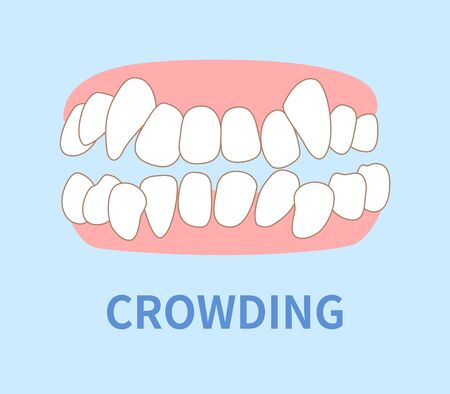 priebus illustrations; crowding, opposite occlusion, open bite, maxillary anterior protrusion, cavities, dentition, crossbiteのイラスト素材