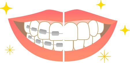 Tooth alignment Dental care Before orthodontic treatment After treatmentのイラスト素材