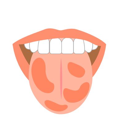 Illustration of tongue symptoms and healthの写真素材