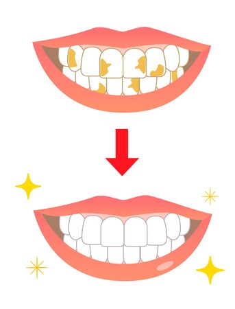 Tooth  Whitening Yellowing Before Afterの写真素材