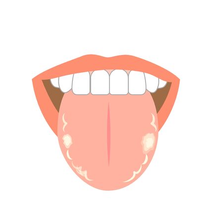 Illustration of tongue symptoms and healthの写真素材