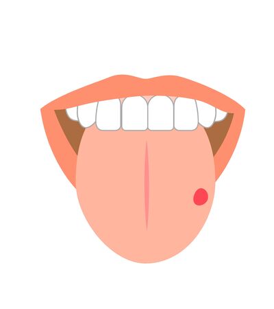 Illustration of tongue symptoms and healthの写真素材