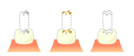 Dental Inlay Caries and Progression and Treatment: Dental Illustrationのイラスト素材