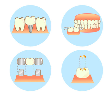 Implant Caries and Progression and Treatment: Dental Illustrationのイラスト素材