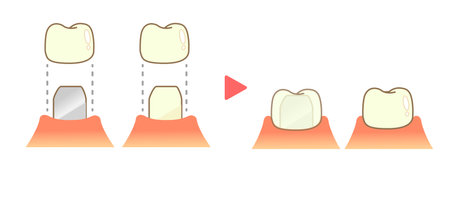 Crown Caries and Progression and Treatment: Dental Illustrationのイラスト素材