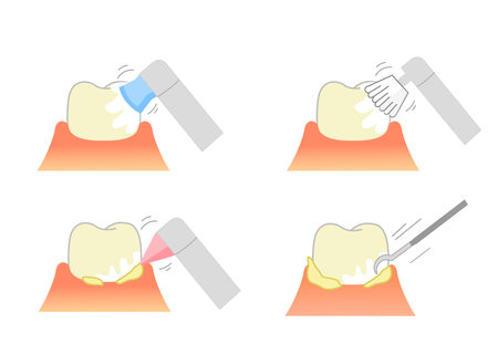 PMTC:Professional Mechanical Tooth Cleaning  Dental Illustrationのイラスト素材