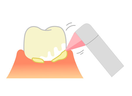 PMTC:Professional Mechanical Tooth Cleaning  Dental Illustrationのイラスト素材