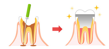 Caries and Progression and Treatment: Dental Illustrationのイラスト素材