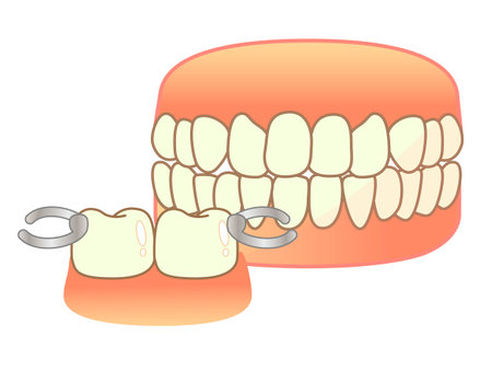 Denture Illustration Set: Denture Illustrationのイラスト素材