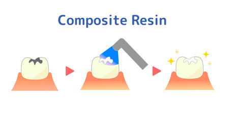 Illustration of composite resin CR adhesive restoration methodのイラスト素材
