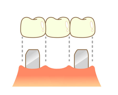 Bridge Caries and Progression and Treatment: Dental Illustrationのイラスト素材