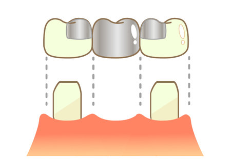 Crown Caries and Progression and Treatment: Dental Illustrationのイラスト素材