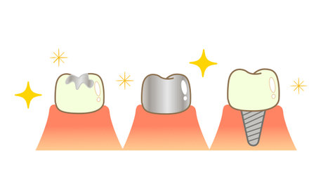 Implant Caries and Progression and Treatment: Dental Illustrationのイラスト素材