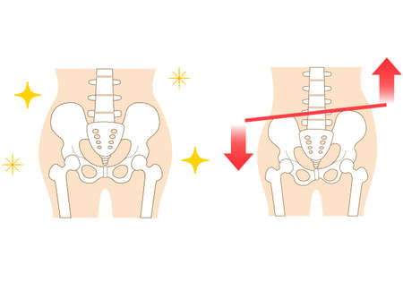 Left-right tilted pelvis and postureのイラスト素材