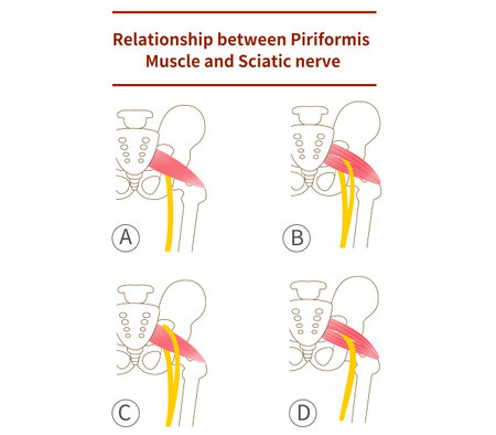 Illustration of piriformis and sciatic nerve