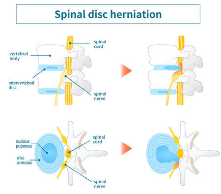Illustration of lumbar disc herniationのイラスト素材