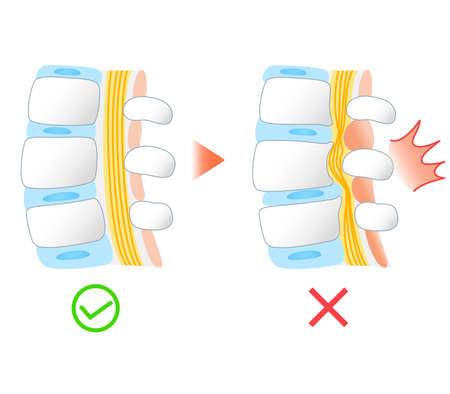 Illustration of lumbar spinal canal stenosisのイラスト素材