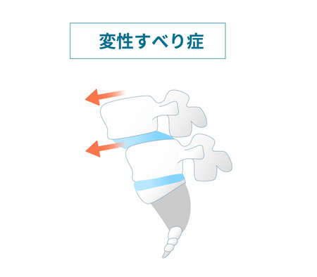 Illustration of  the Spondylolisthesis Symptomsのイラスト素材