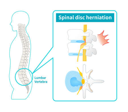 Illustration of lumbar disc herniationのイラスト素材