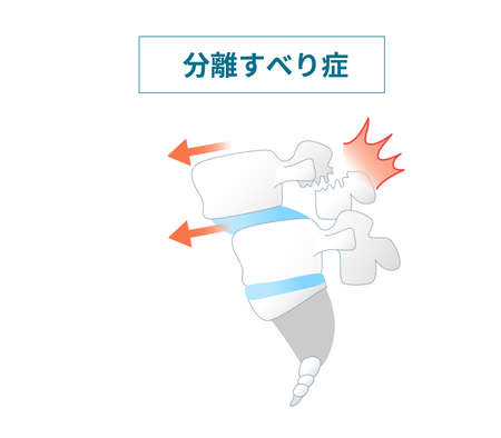 Illustration of  the Spondylolisthesis Symptomsのイラスト素材