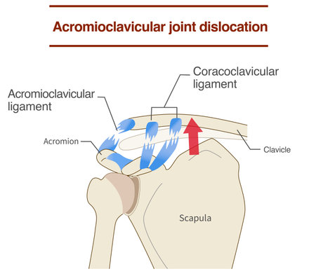 Dislocation of the acromioclavicular joint and ligaments and its mechanismのイラスト素材