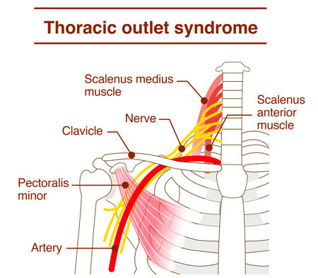 Mechanisms and Causes of Thoracic Outlet Syndromeのイラスト素材