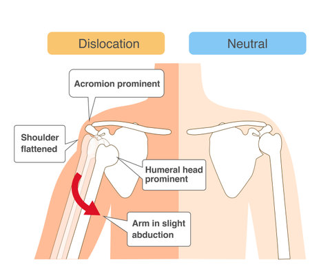 Comparative chart of shoulder joint dislocation mechanismのイラスト素材