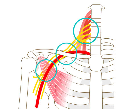Three gaps that cause thoracic outlet syndromeのイラスト素材