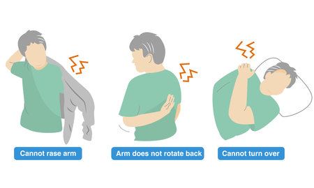 Illustration of a person with a sore shoulder and an arm that cannot lift.Impingement Syndromeのイラスト素材