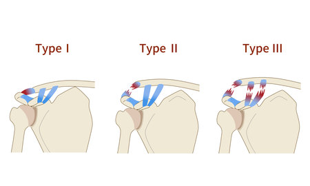 The three stages of acromioclavicular dislocationのイラスト素材