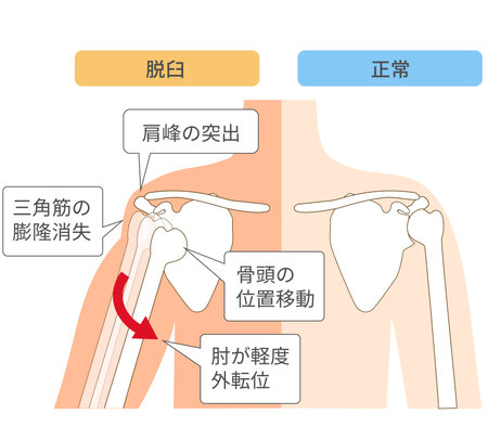 Comparison diagram of the mechanism of shoulder dislocationのイラスト素材