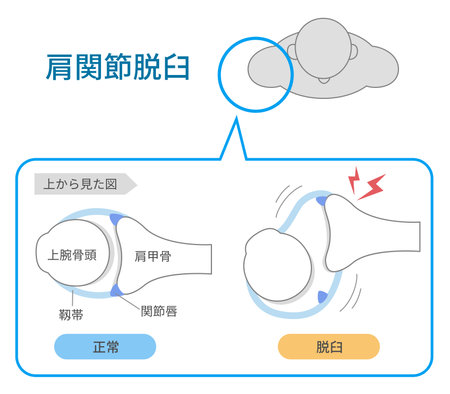Mechanism and causes of shoulder dislocation seen from aboveのイラスト素材