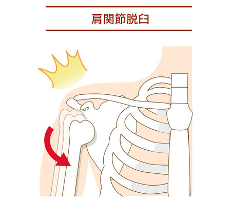 How shoulder dislocation worksのイラスト素材