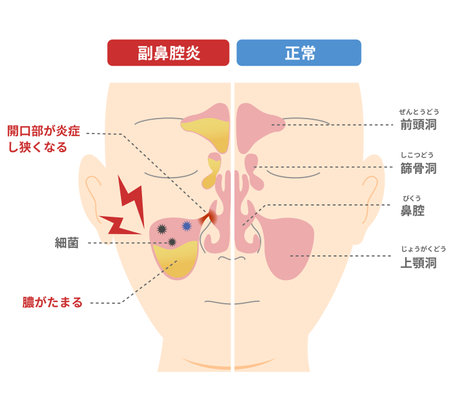 Comparative chart of how and why chronic sinusitis occursのイラスト素材