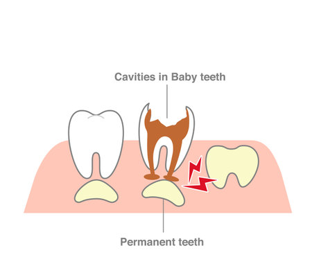 The process where a permanent tooth pushes through and replaces a decayed baby tooth by dissolving it.のイラスト素材